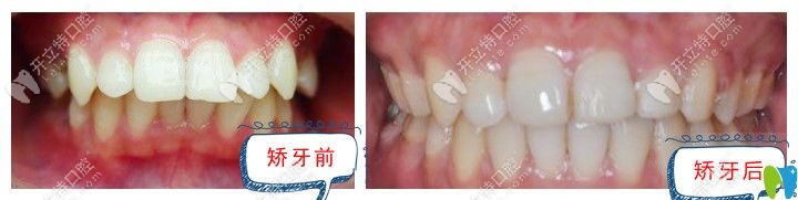 東莞好佰年齙牙矯正案例圖
