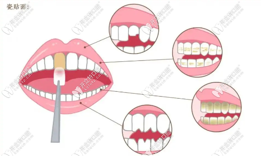 牙貼面時(shí)間久了牙齒會(huì)不會(huì)爛