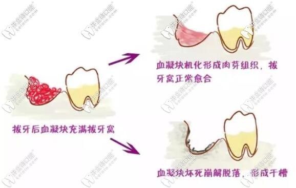 拔牙48小時內(nèi)冷敷