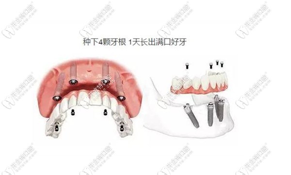 郑州半全口种植牙价格