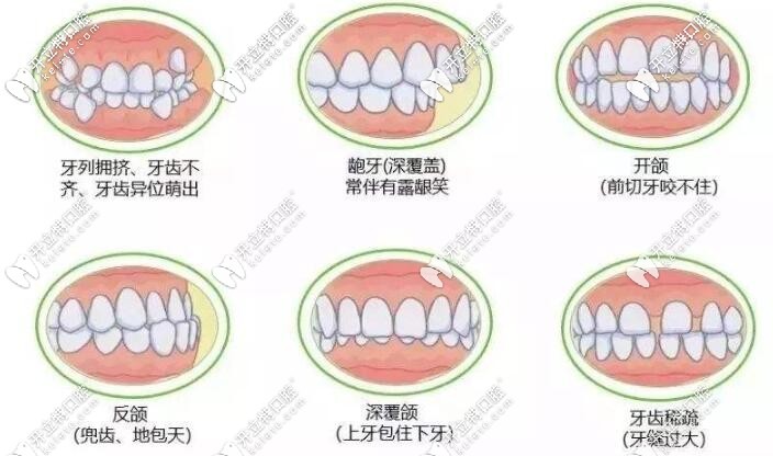 牙齒不齊的危害