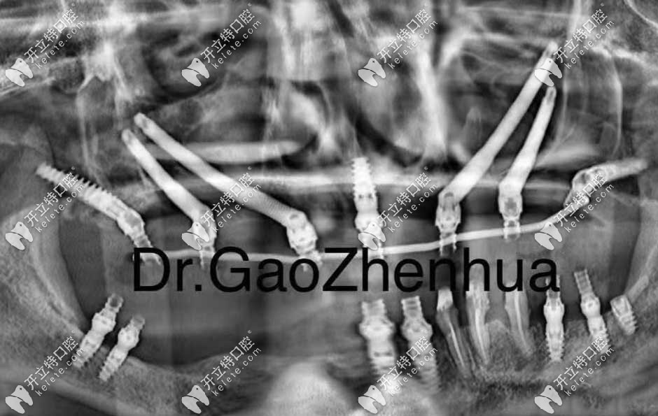 穿顴穿翼種植病例一