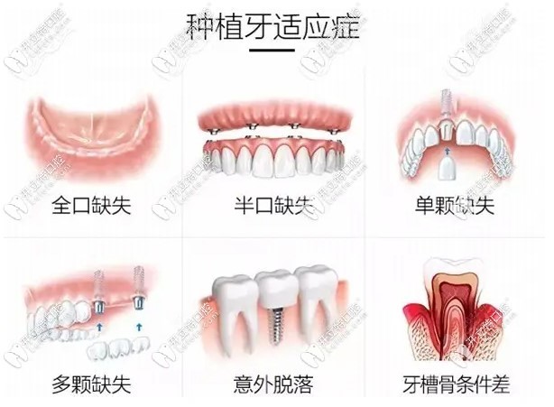 六盤水好佰年口腔全口種植牙收費(fèi)標(biāo)準(zhǔn)