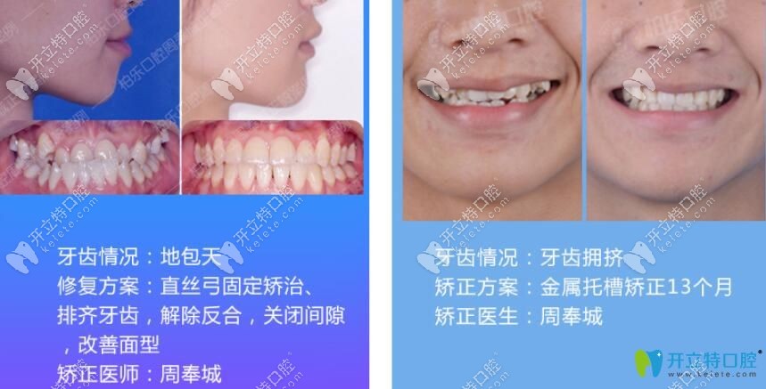 周奉城醫(yī)生地包天矯正+牙齒擁擠不齊矯正案例