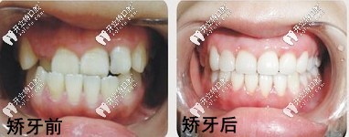 矫正前后对比