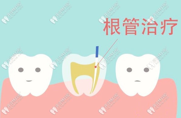 根管治療