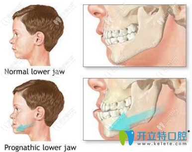 牙齒畸形給學(xué)生帶來(lái)五大危害