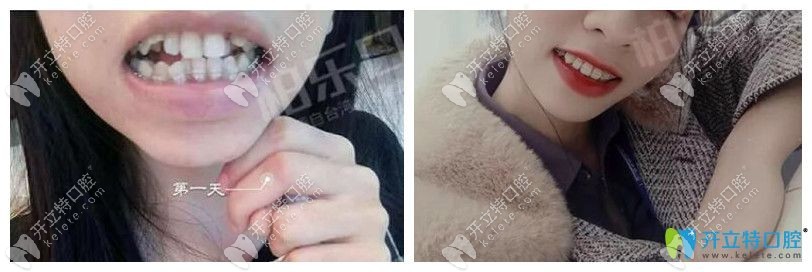 南寧柏樂口腔真人正畸案例來驗證它靠不靠譜