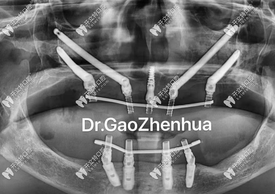 穿顴穿翼種植病例二