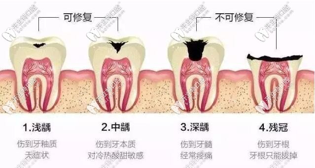 什么情況的牙齒適合做根管治療