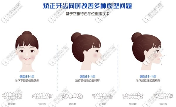 正雅矯正技術(shù)在矯治牙齒的同時(shí)還能改善面型問題