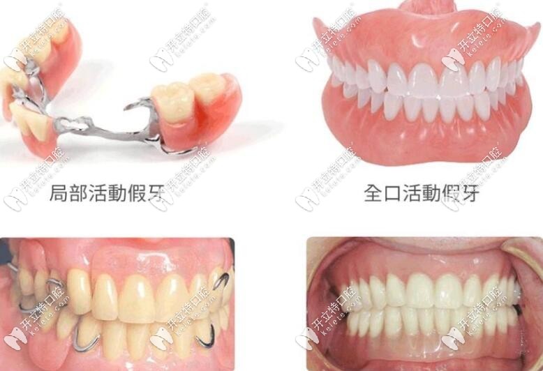 牙托用純鈦和鈦合金哪個好？