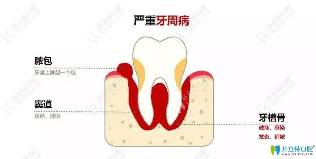 牙周炎牙齦膿包