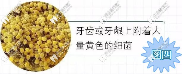 牙齿和牙龈上的细菌