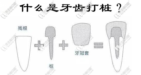 什么是牙齒打樁