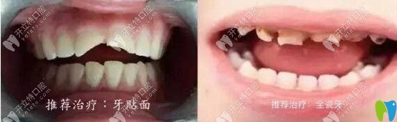 全瓷牙和牙贴面适应症状