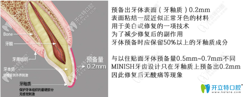 韓國今日安牙科minish牙齒貼面磨牙量示意圖