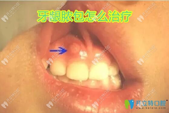 牙齦膿包怎么治療