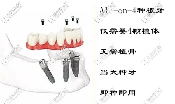 深圳allon4即刻负重种植牙价格
