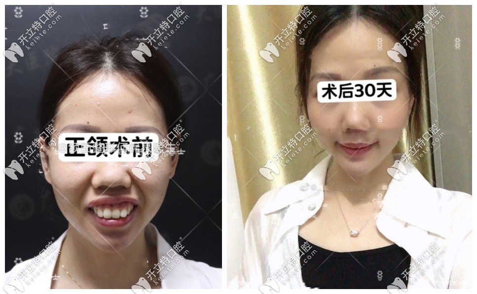 凸嘴+露龈笑正颌手术后脸型改变图对比
