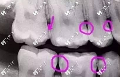 牙齿有龋齿的样子