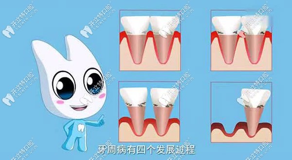 牙周炎的四個發(fā)展過程圖