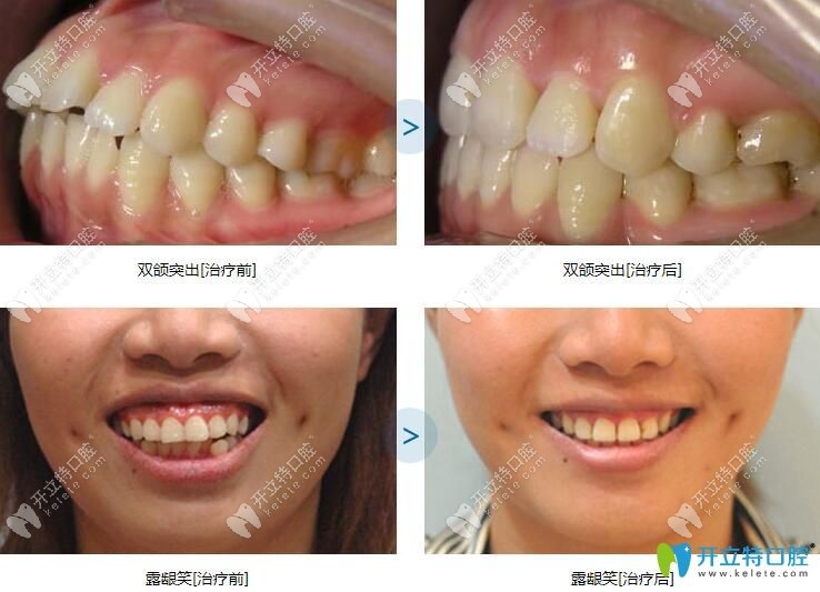 泉州維樂口腔的真人正畸案例