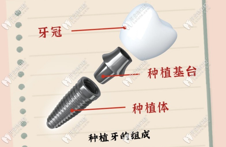 来看看种植体由哪几部分组成