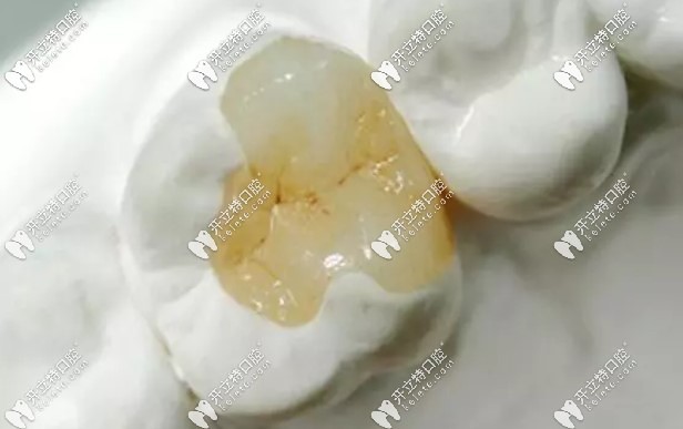 嵌體補(bǔ)牙圖片