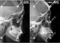 牙性凸嘴和骨性ct情況