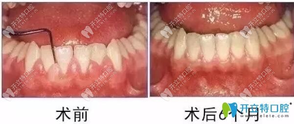 牙周炎引起的牙齦膿包治療