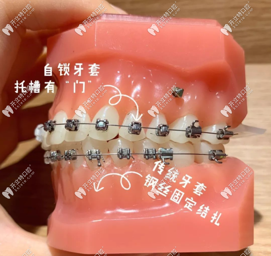 仙游口腔牙齒矯正費用是多少錢
