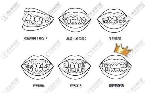 牙齿不齐的危害