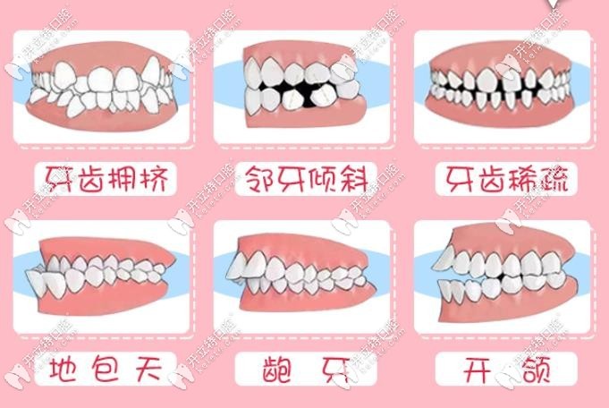 陳思醫(yī)生擅長矯正的牙齒類型