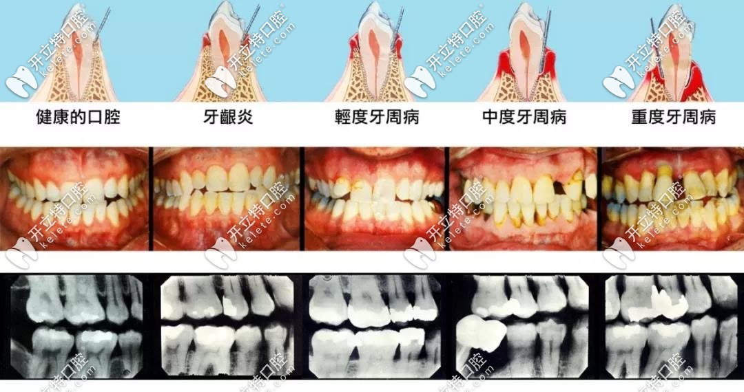 龋齿牙周炎一定要尽早治疗