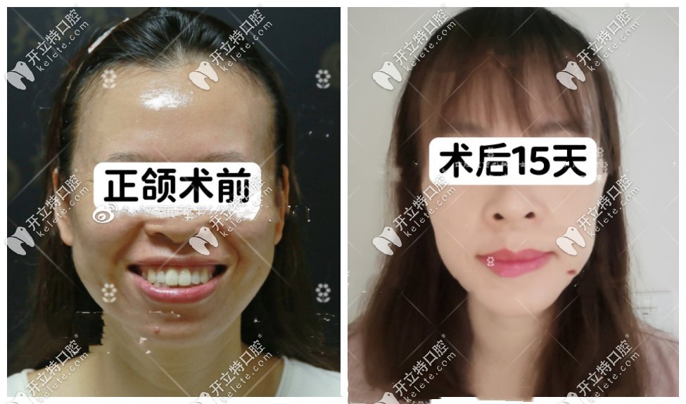 骨性龅牙做正颌手术病例