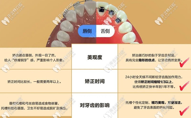舌側(cè)矯正對比傳統(tǒng)矯正的優(yōu)勢
