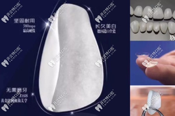 牙齿修复瓷贴面