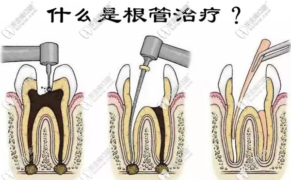 什么是根管治療