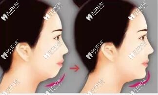 凸嘴下巴后縮