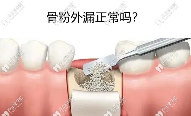 骨粉外漏正常嗎