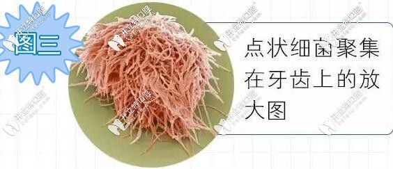 牙齿放大后上面的点状细菌