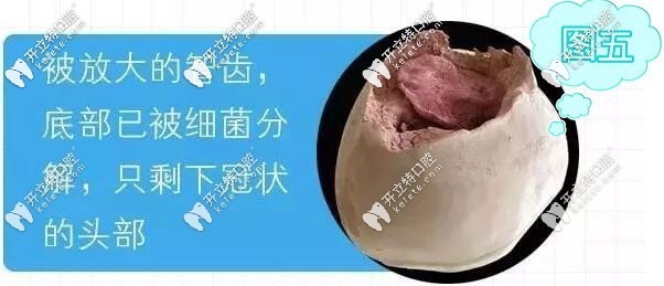 放大后的龋齿