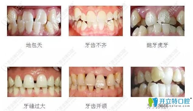 常見(jiàn)的幾種需要做牙齒矯正的圖片