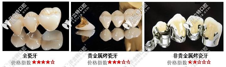 不同补牙方式价格不同