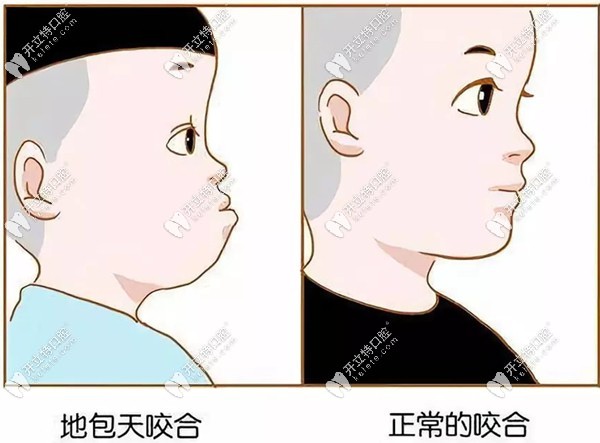 兒童正常咬合和畸形咬合對比