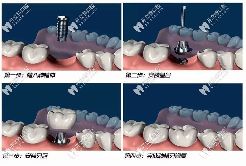 看看種植牙手術(shù)的流程和步驟是什么吧