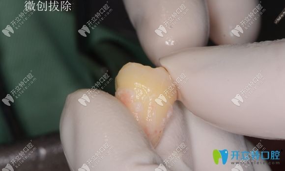 自體移植牙的成功與否與醫(yī)生操作技術(shù)關(guān)系密切