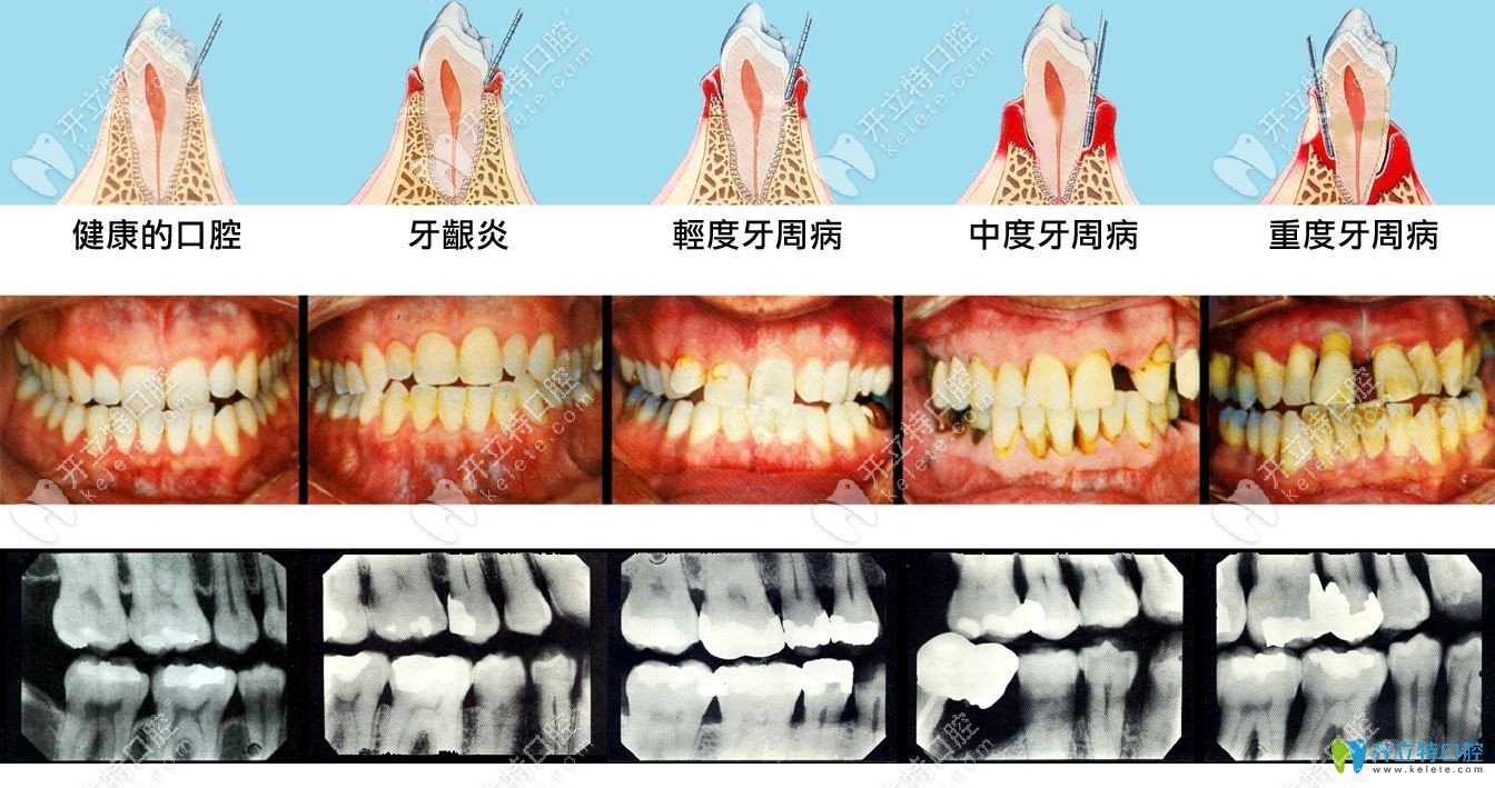牙周病發(fā)展過程