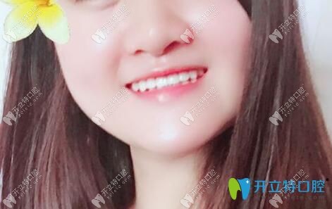 骨性地包天掩饰矫正案例
